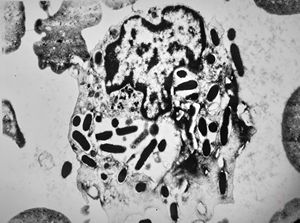 F,43y. | blood - leukemia - bacteriaemia - phagocytosed microbes F,43y. | blood - leukemia - bacteriaemia - phagocytosed microbes